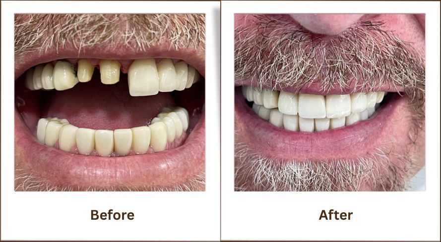 When You Might Need Dental Crowns